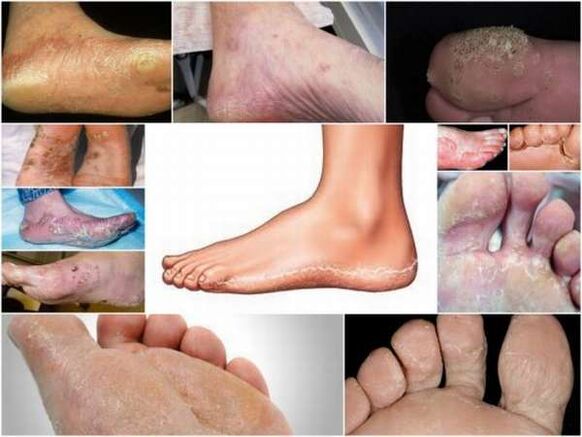 Ακανθοκυτταρικό καρκίνωμα-υπερκερατωτική μορφή μυκητίασης των ποδιών