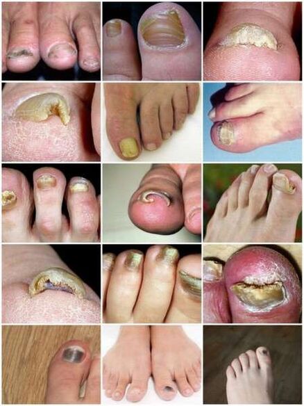 Μυκητιασική λοίμωξη της πλάκας των νυχιών