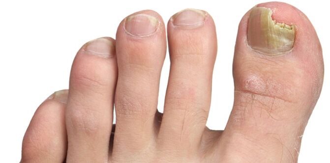 Μυκητιακή μόλυνση της πλάκας των νυχιών